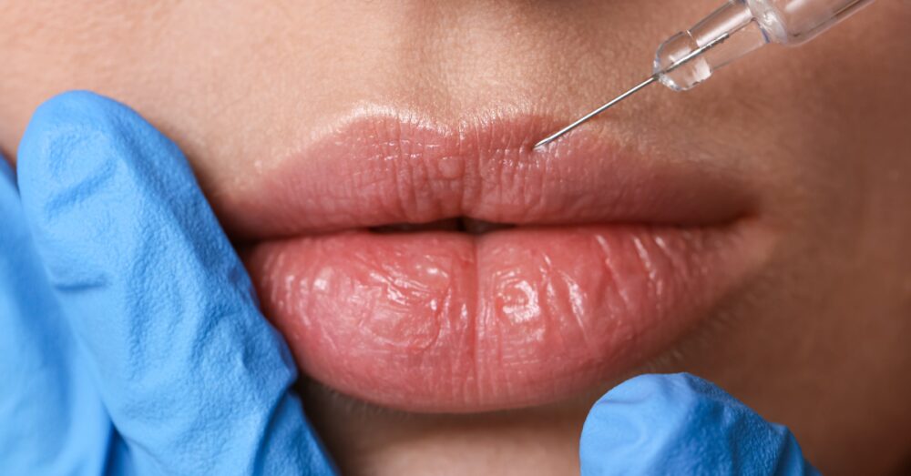 Close up of a woman receiving lip filler injections from a gloved provider